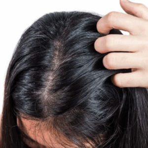 Cabelo Oleoso Nizoral
